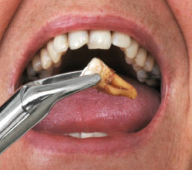 Adult Tooth Extraction